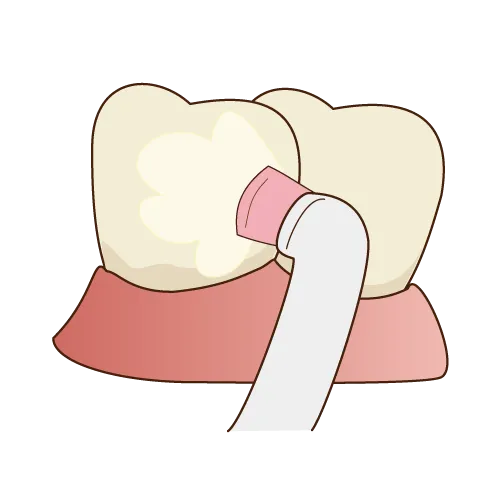 フッ素塗布