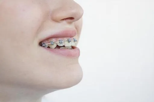 前歯の矯正をしている様子