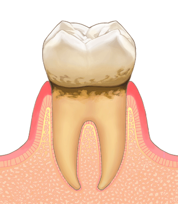 軽度な歯周病