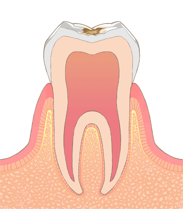 エナメル質のむし歯（C1)