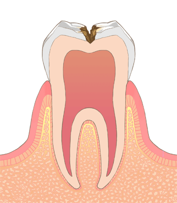 象牙質のむし歯（C2）