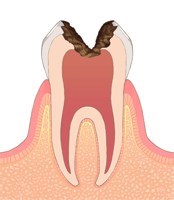 神経まで進んだむし歯（C3）