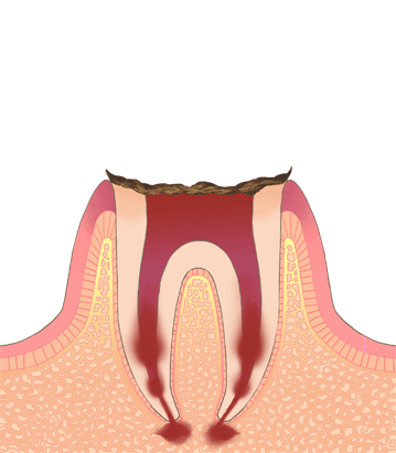 歯の根だけが残った状態のむし歯（C4）